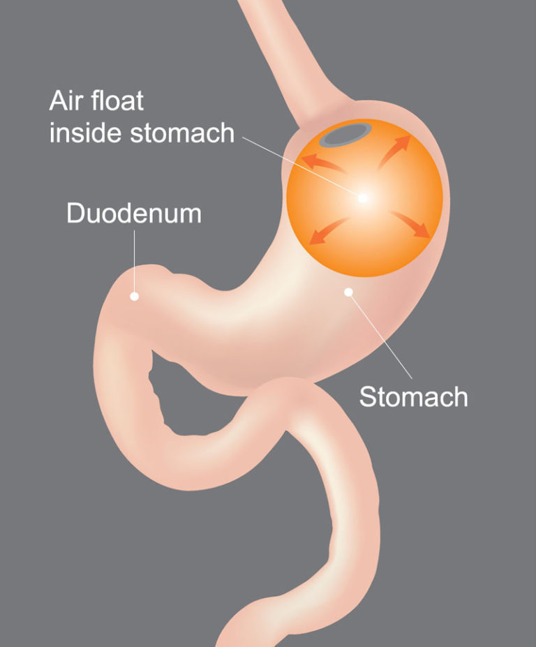 gastric-balloon-weight-loss-surgery-for-less-health-travel-guide