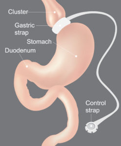 gastric band surgery visual