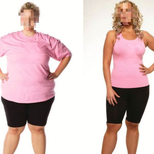 Story of Aino – Gastric Bypass surgery Case Study Health Travel Guide