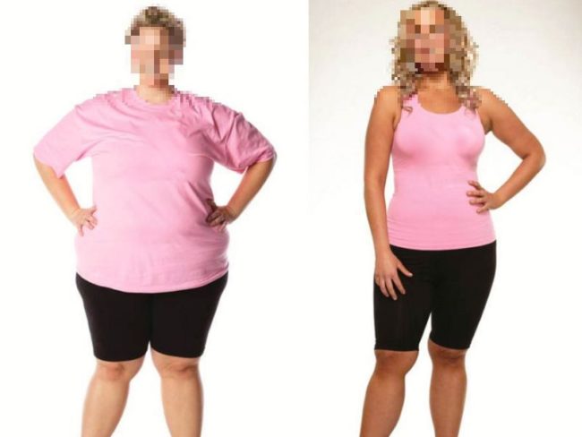 Story of Aino – Gastric Bypass surgery Case Study Health Travel Guide