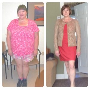 Weight Loss Surgery Before and After Photos - Health Travel Guide