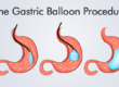 The-Gastric-Balloon-Procedures-HealthTravelGuide-760x434