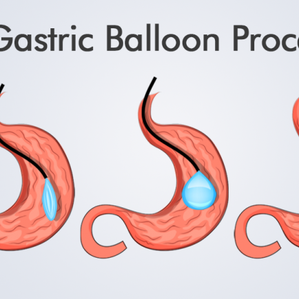 The-Gastric-Balloon-Procedures-HealthTravelGuide-760×434 The-Gastric-Balloon-Procedures-HealthTravelGuide-760x434