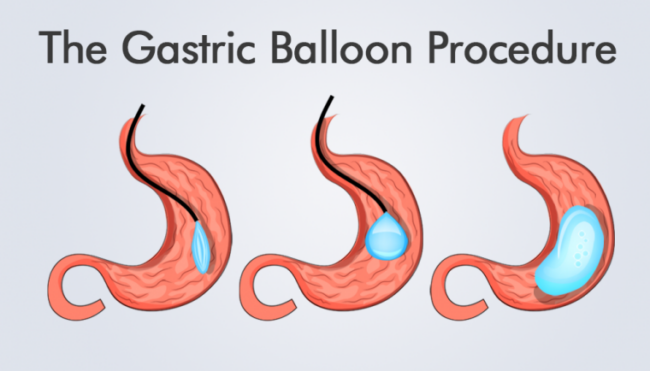 The-Gastric-Balloon-Procedures-HealthTravelGuide-760×434 The-Gastric-Balloon-Procedures-HealthTravelGuide-760x434