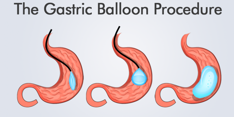 Hectare Imitatie Perforatie What You Need to Know About Gastric Balloon Procedure
